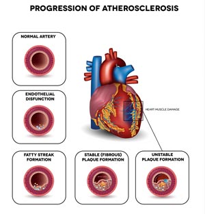 Atherosclerosis | Glenwood Medical Associates