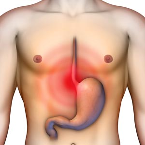 GERD Reflux Disease | Glenwood Medical Associates